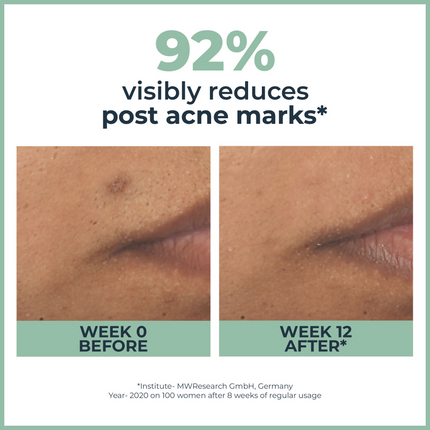 Eucerin Dermopurifyer Toner Cleansing Gel & Serum Combo